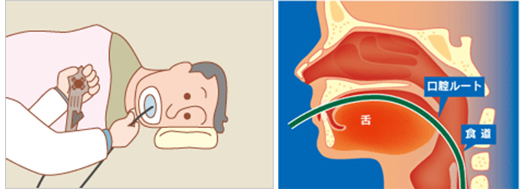 経口内視鏡